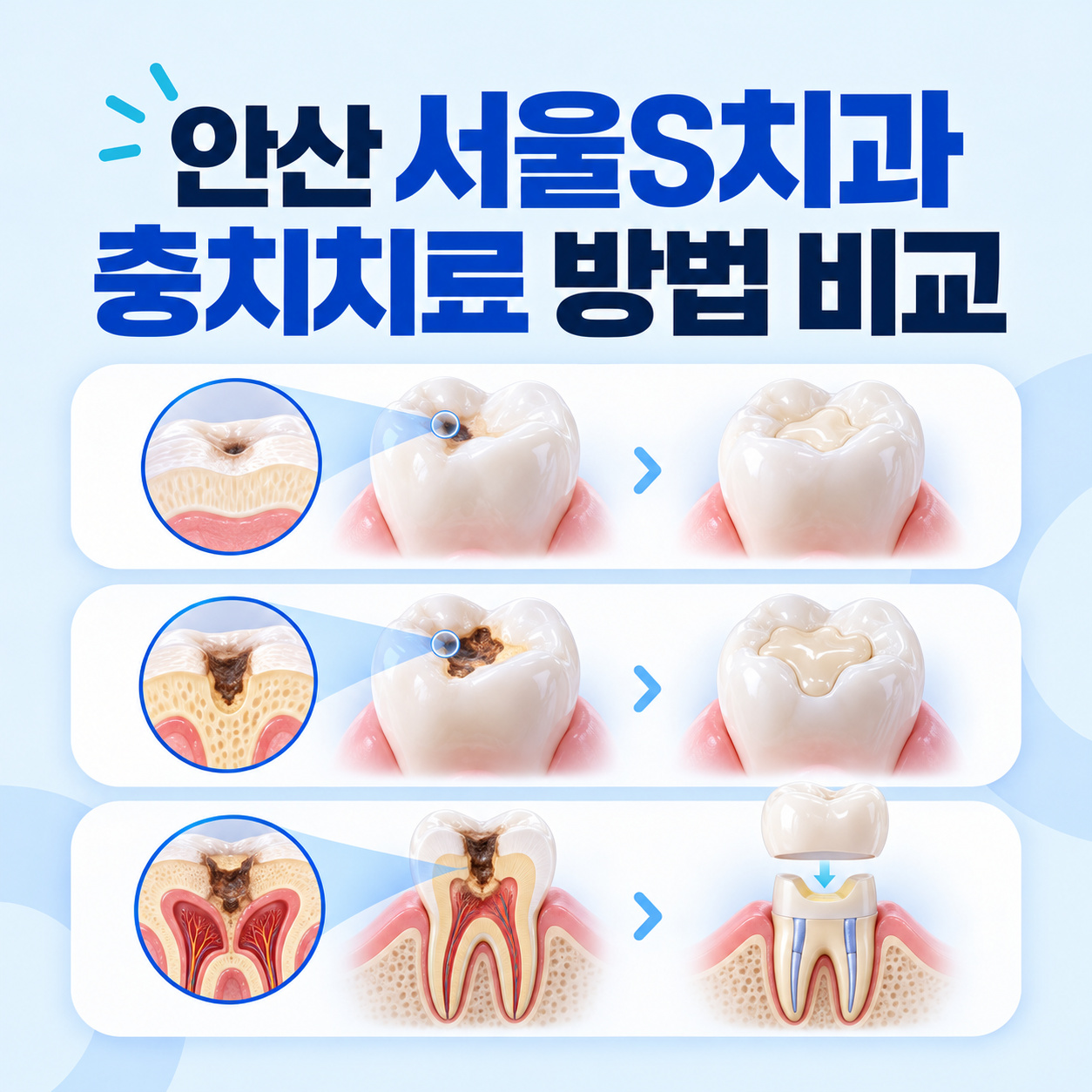 안산 고잔동 서울S치과 충치치료 레진 인레이 신경치료 단계 비교
