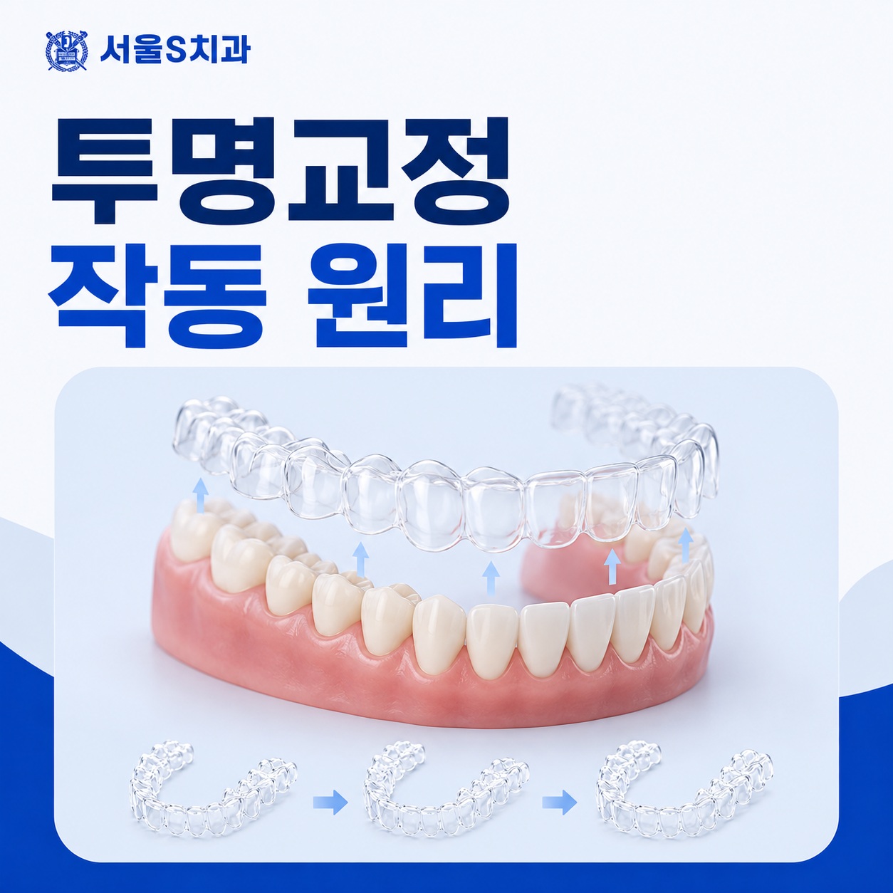 안산 호수동 치과 투명교정 원리 설명