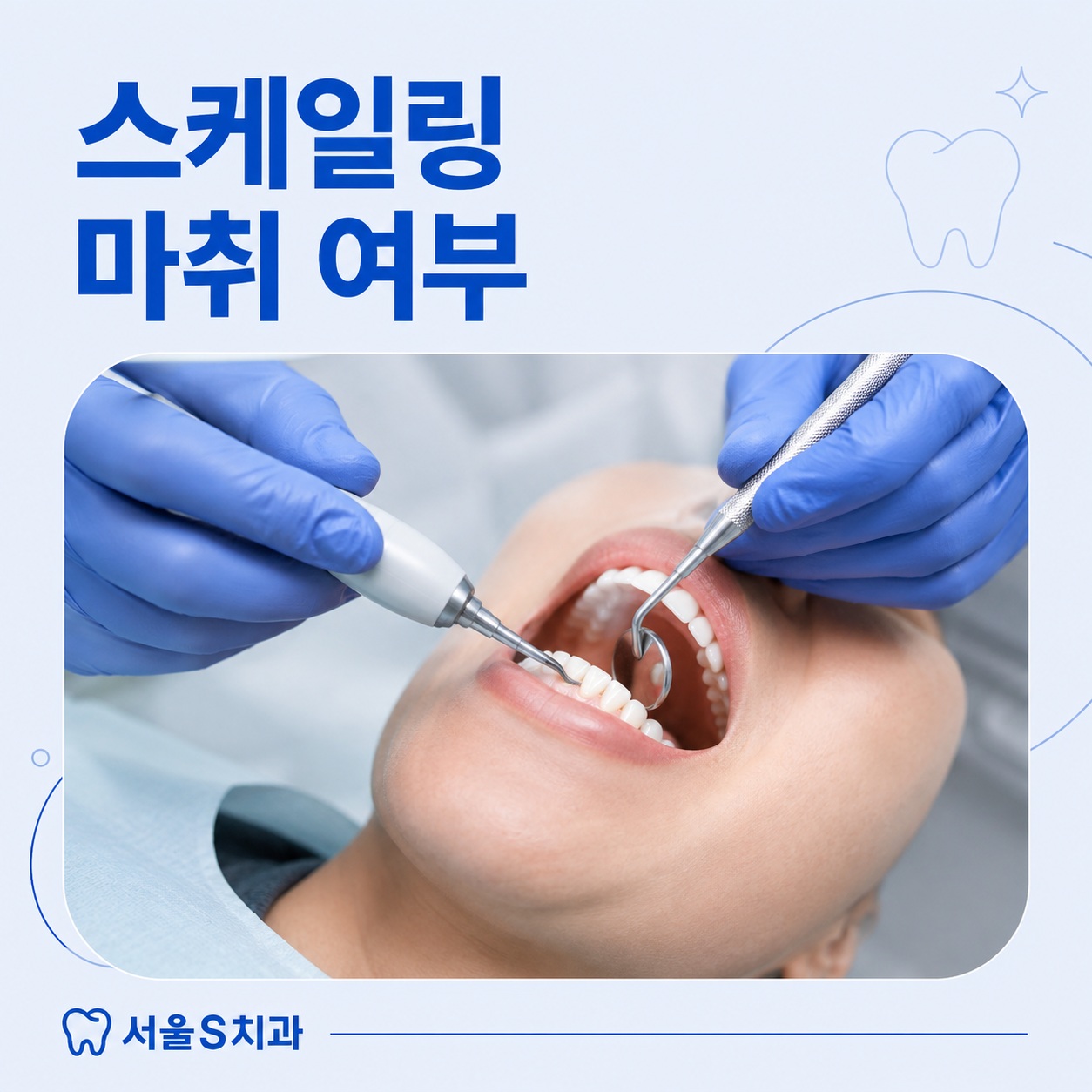 안산 호수동 치과 스케일링 마취 여부 안내