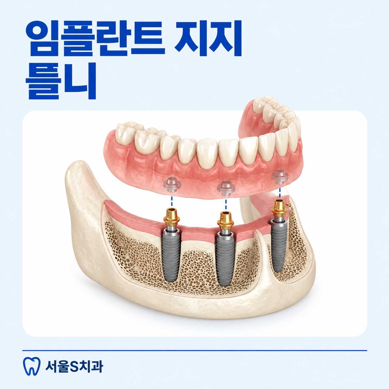 안산 중앙동 치과 임플란트 지지 틀니 시술