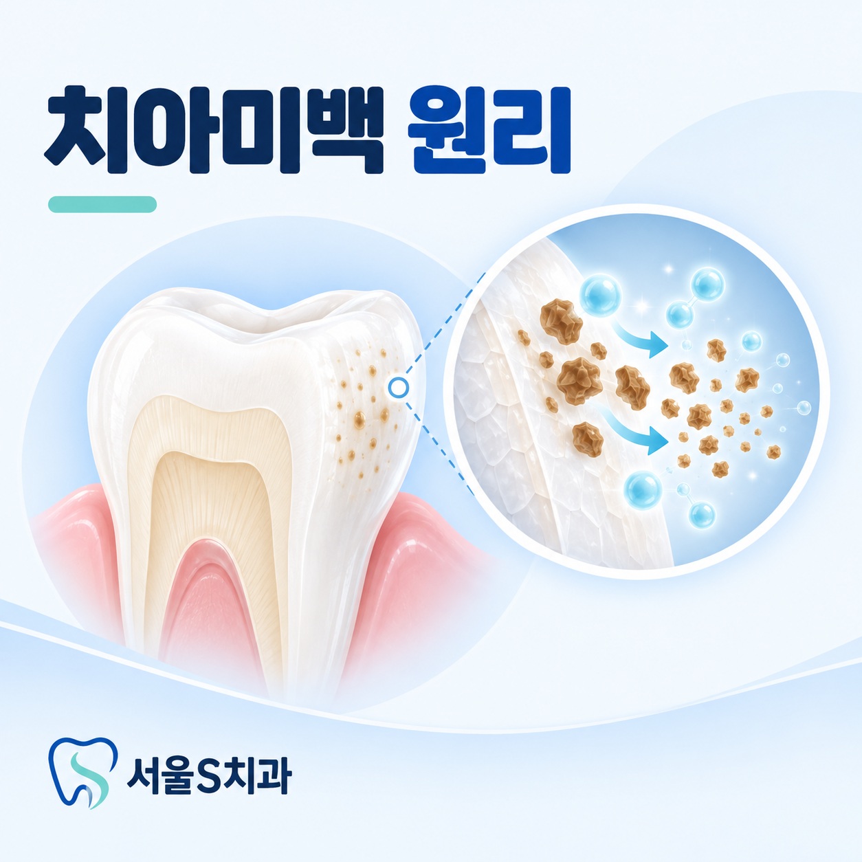 치아미백 원리 안산 중앙동 서울S치과 치아미백 원리 설명