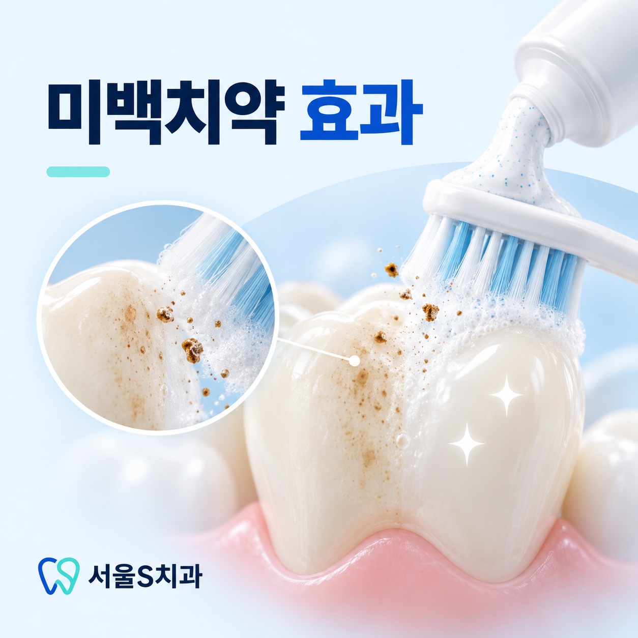 미백치약 효과 안산 중앙동 서울S치과 미백치약 효과 설명