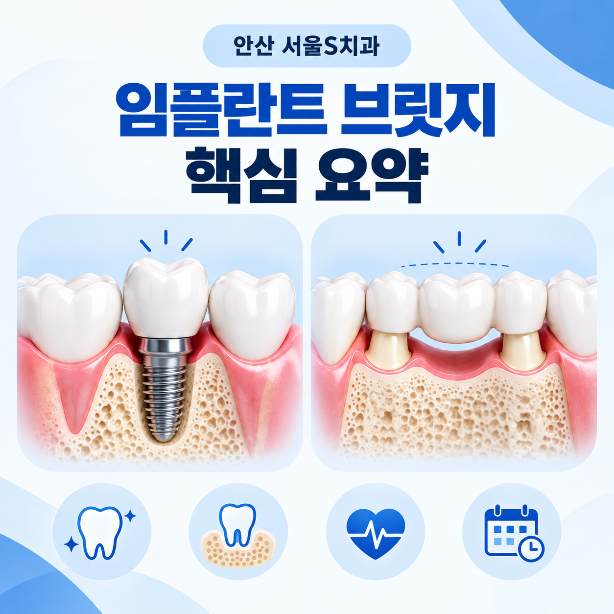 안산 서울S치과 임플란트 브릿지 상담 전 확인할 조건