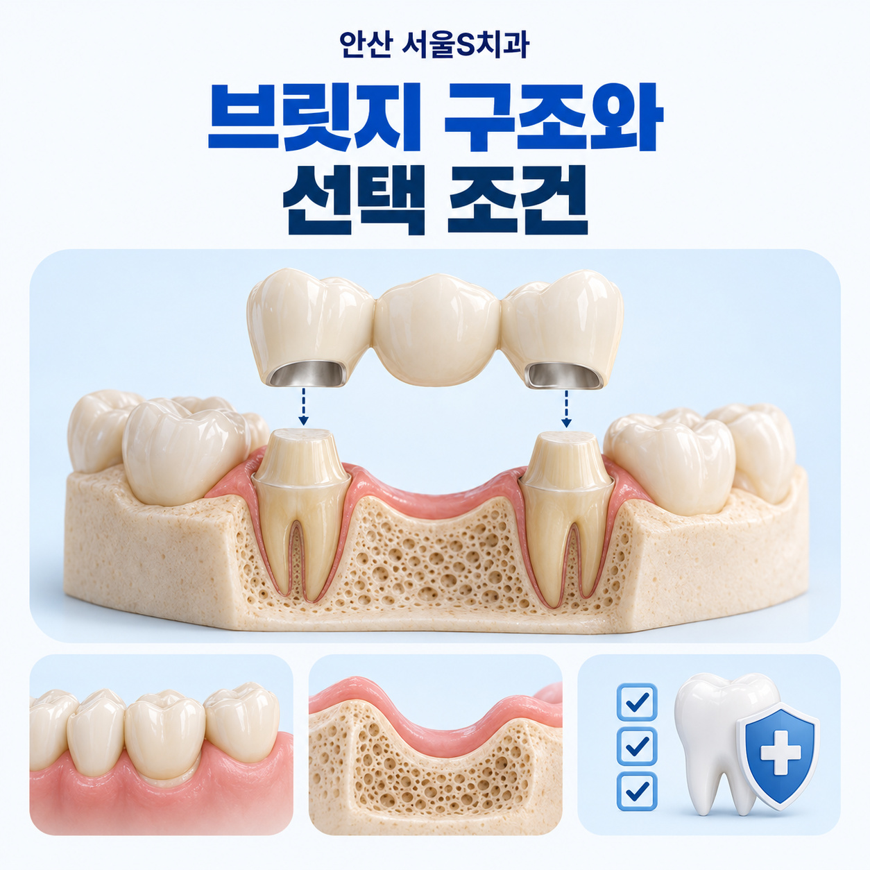 안산 서울S치과 브릿지 지지 치아와 임플란트 검토 조건