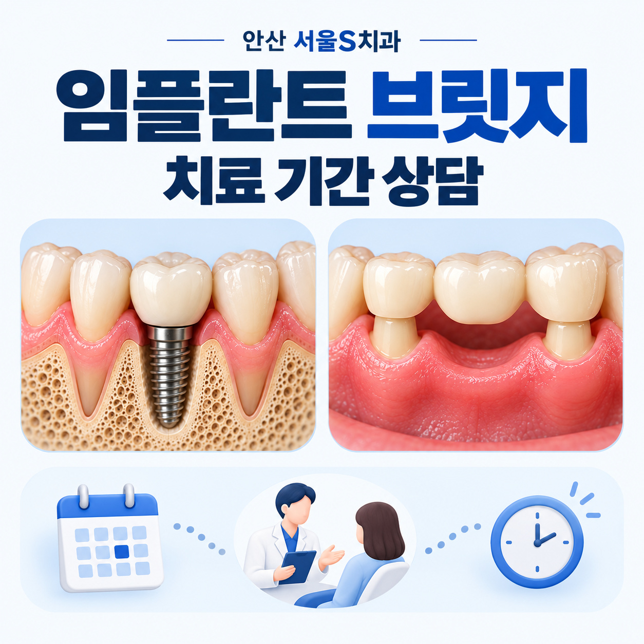안산 서울S치과 임플란트 골유착 기간과 브릿지 치료 일정 비교