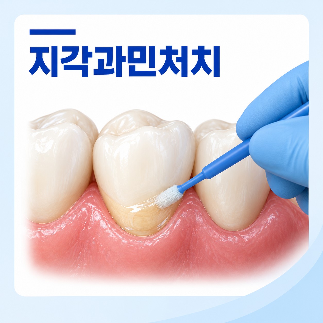 안산 서울S치과 지각과민처치 진료 모습