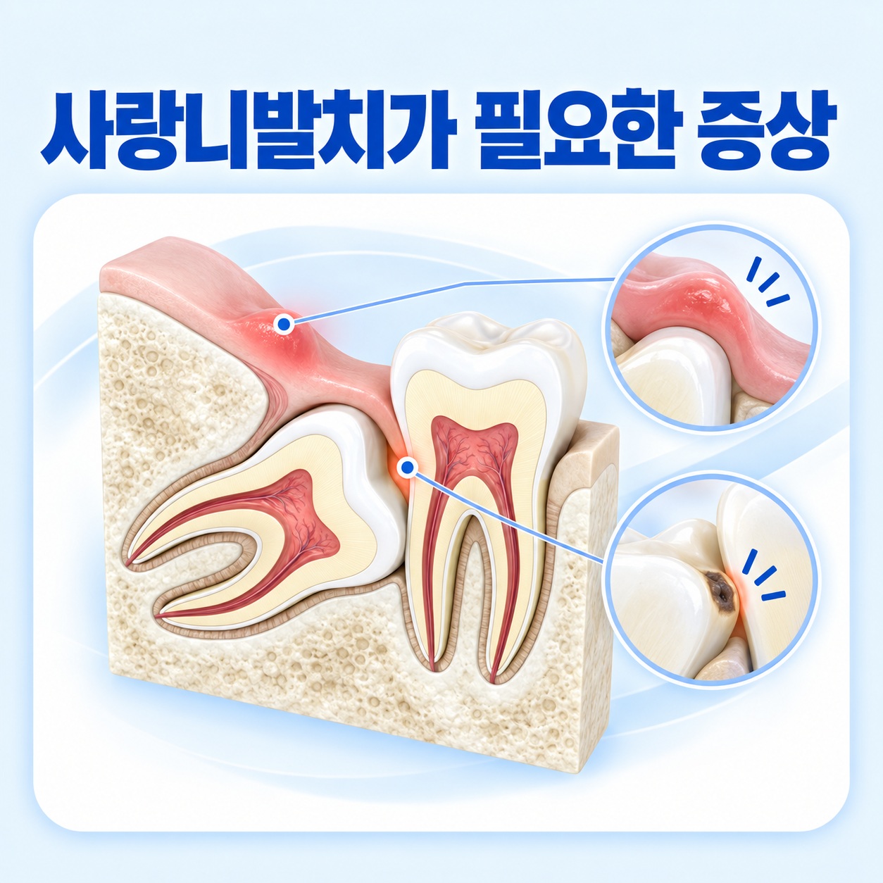 안산 서울S치과 사랑니발치 필요 증상 안내