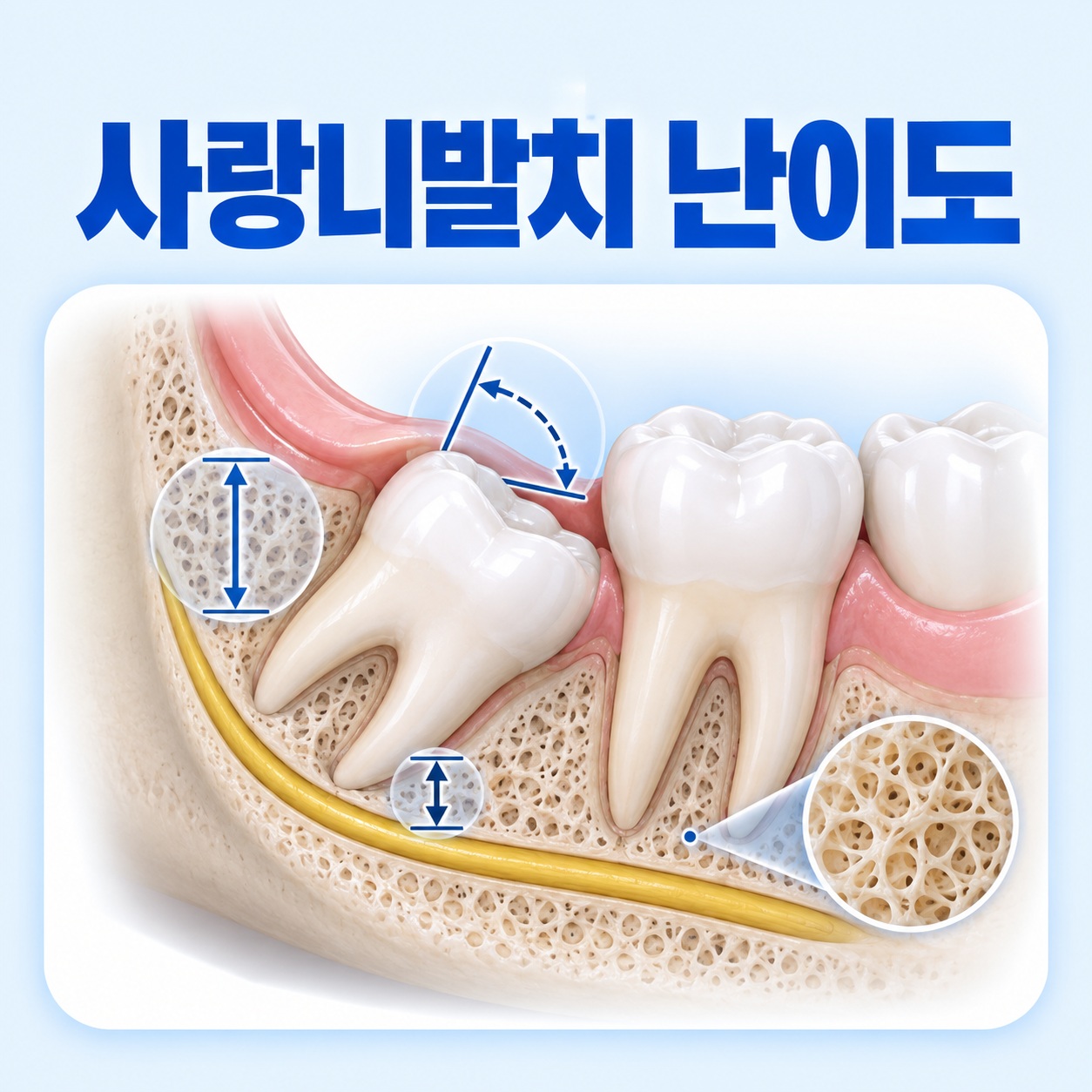 안산 서울S치과 사랑니발치 난이도 안내