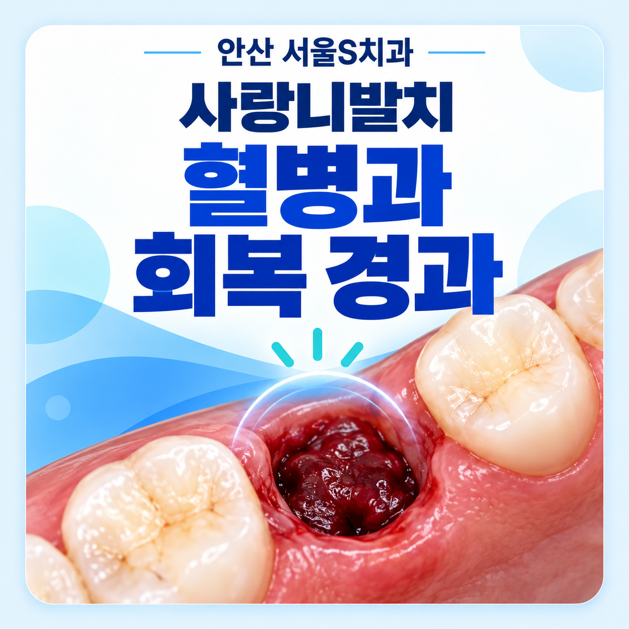 안산 서울S치과 사랑니발치 혈병과 회복 경과 안산 서울S치과 사랑니발치 회복 기간과 혈병의 역할