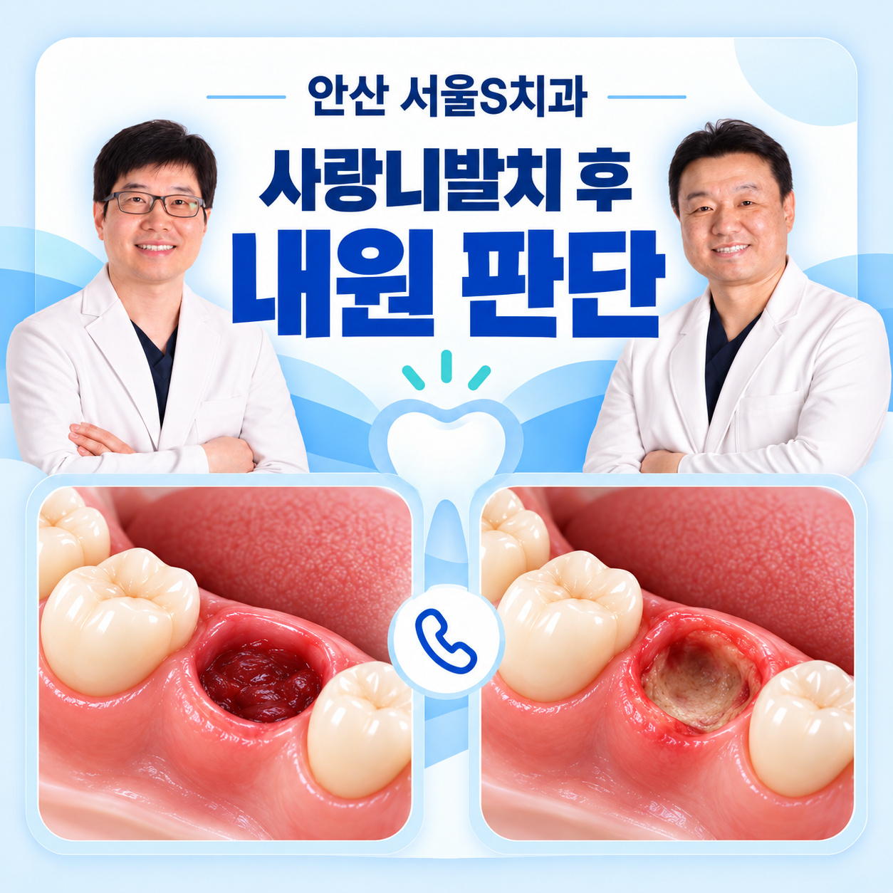 안산 서울S치과 사랑니발치 후 내원 판단 안산 서울S치과 사랑니발치 후 건조소켓 의심 시 치과 확인 안내