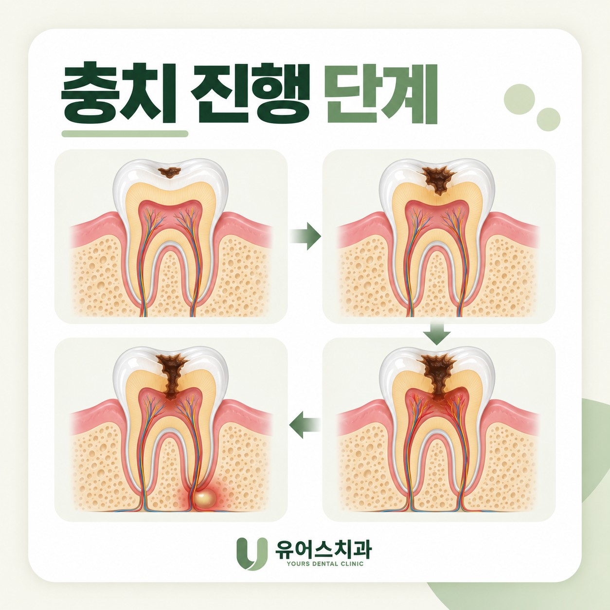 부천시청역 유어스치과 충치 진행 단계별 치료 안내
