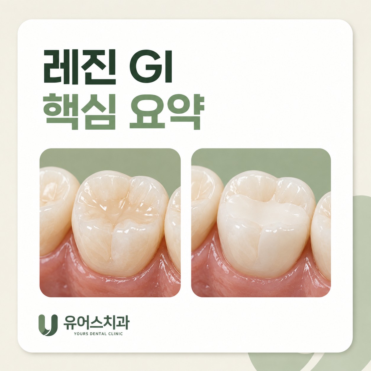 부천시청역 치과 레진 글래스아이오노머 핵심 요약
