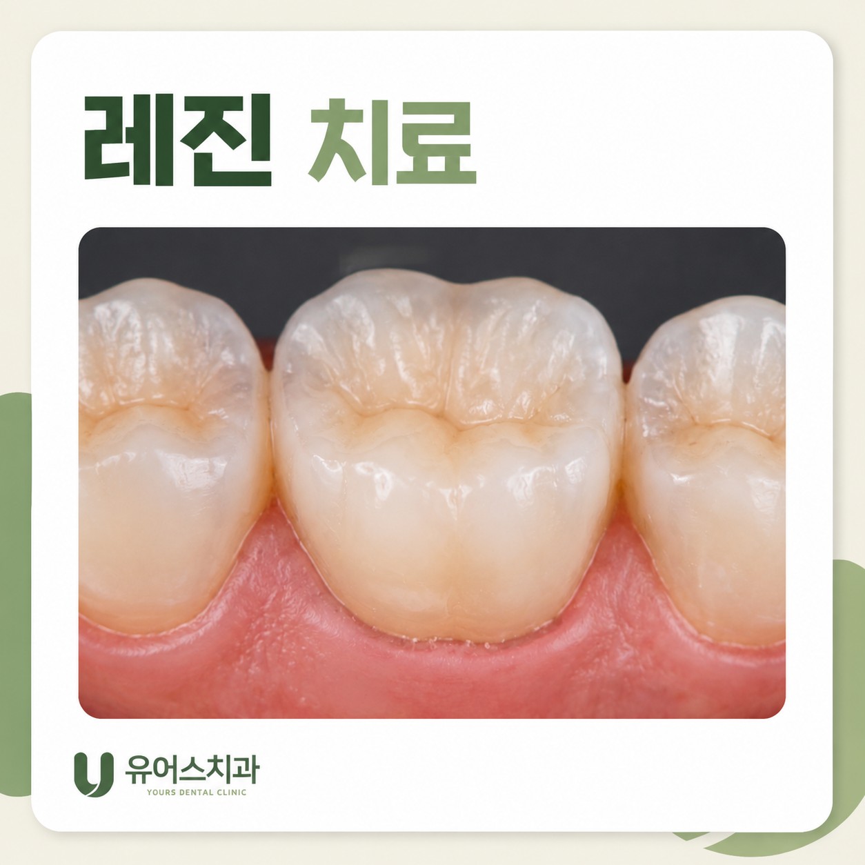 부천시청역 치과 레진 치료 특징
