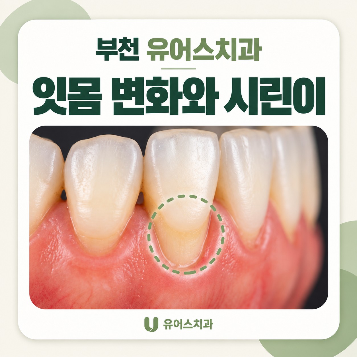 부천시청역 유어스치과의원 치은퇴축과 지각과민증 구강검진