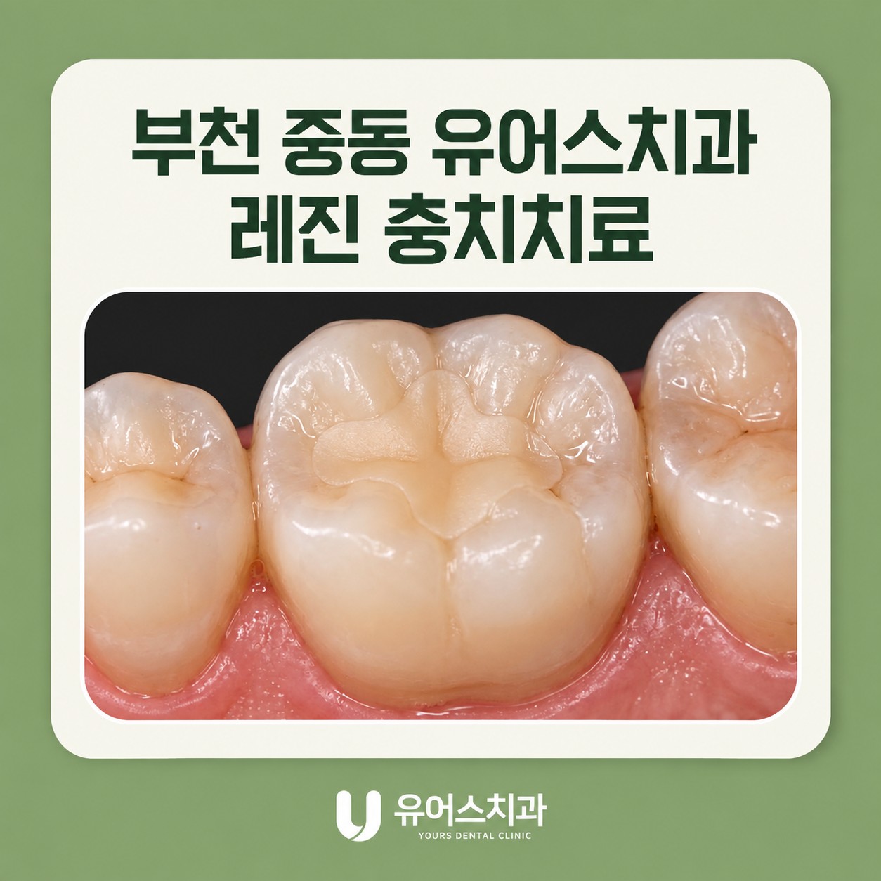 부천 중동 유어스치과 작은 충치의 레진치료 안내