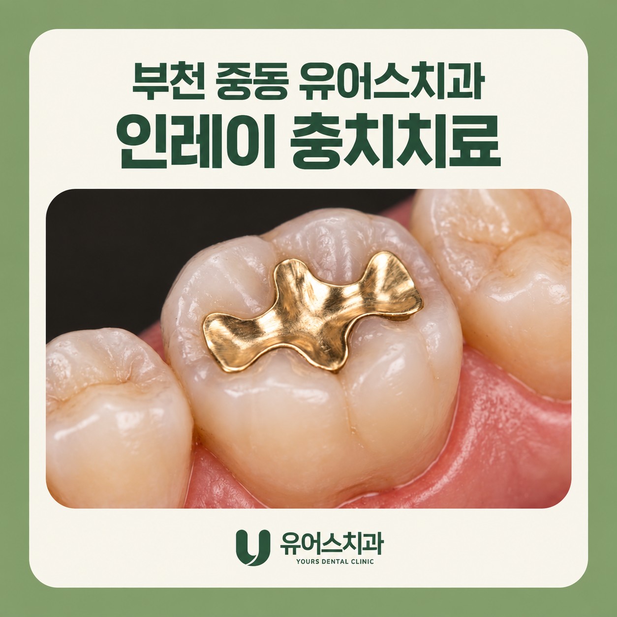 부천 중동 유어스치과 인레이 충치치료 적용 조건과 제작 과정