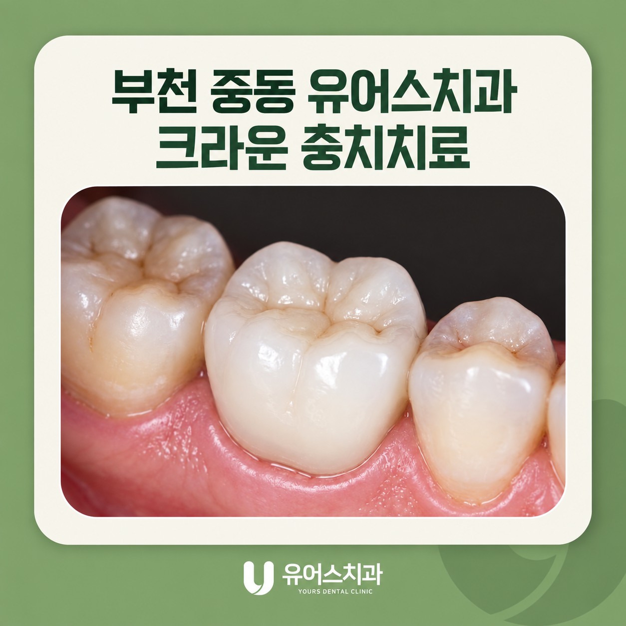 부천 중동 유어스치과 크라운 충치치료와 치아 보호