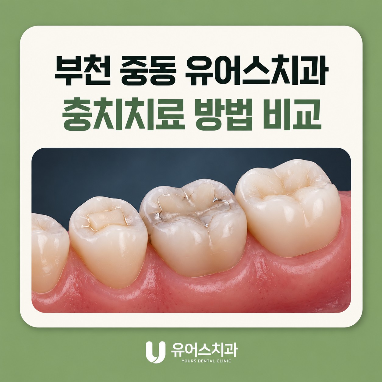 부천 중동 유어스치과 충치치료 레진 인레이 크라운 비교