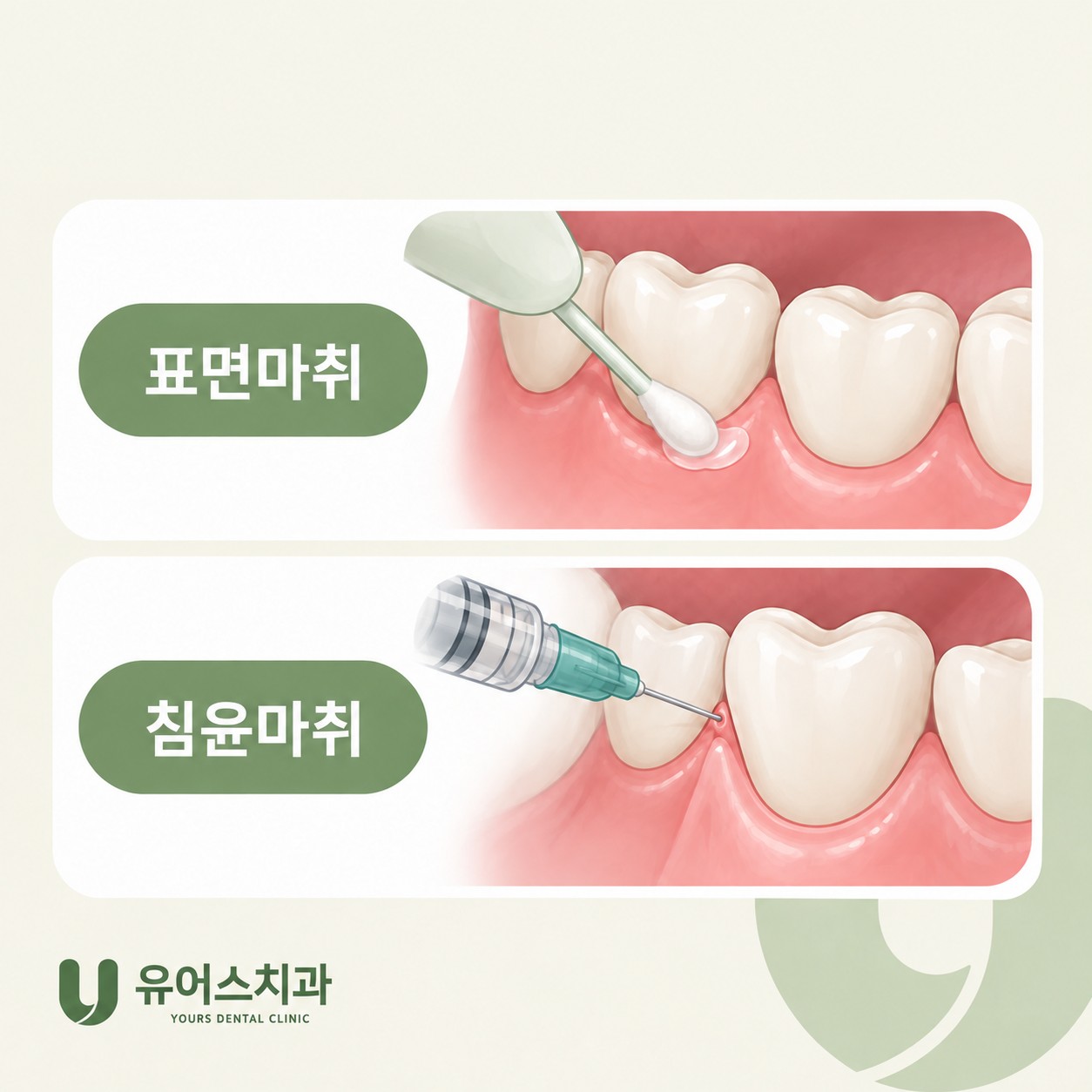 부천중동 유어스치과 표면마취 침윤마취 진행 모습