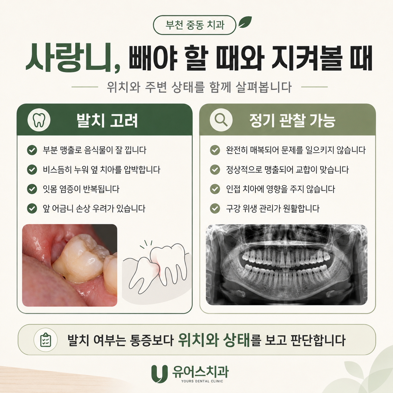 부천 중동 치과 사랑니 진단 사진