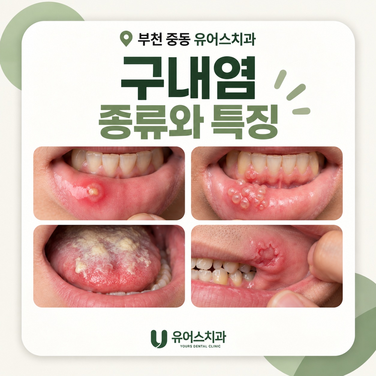 부천 중동 유어스치과 구내염 종류별 특징과 치료 원인 확인