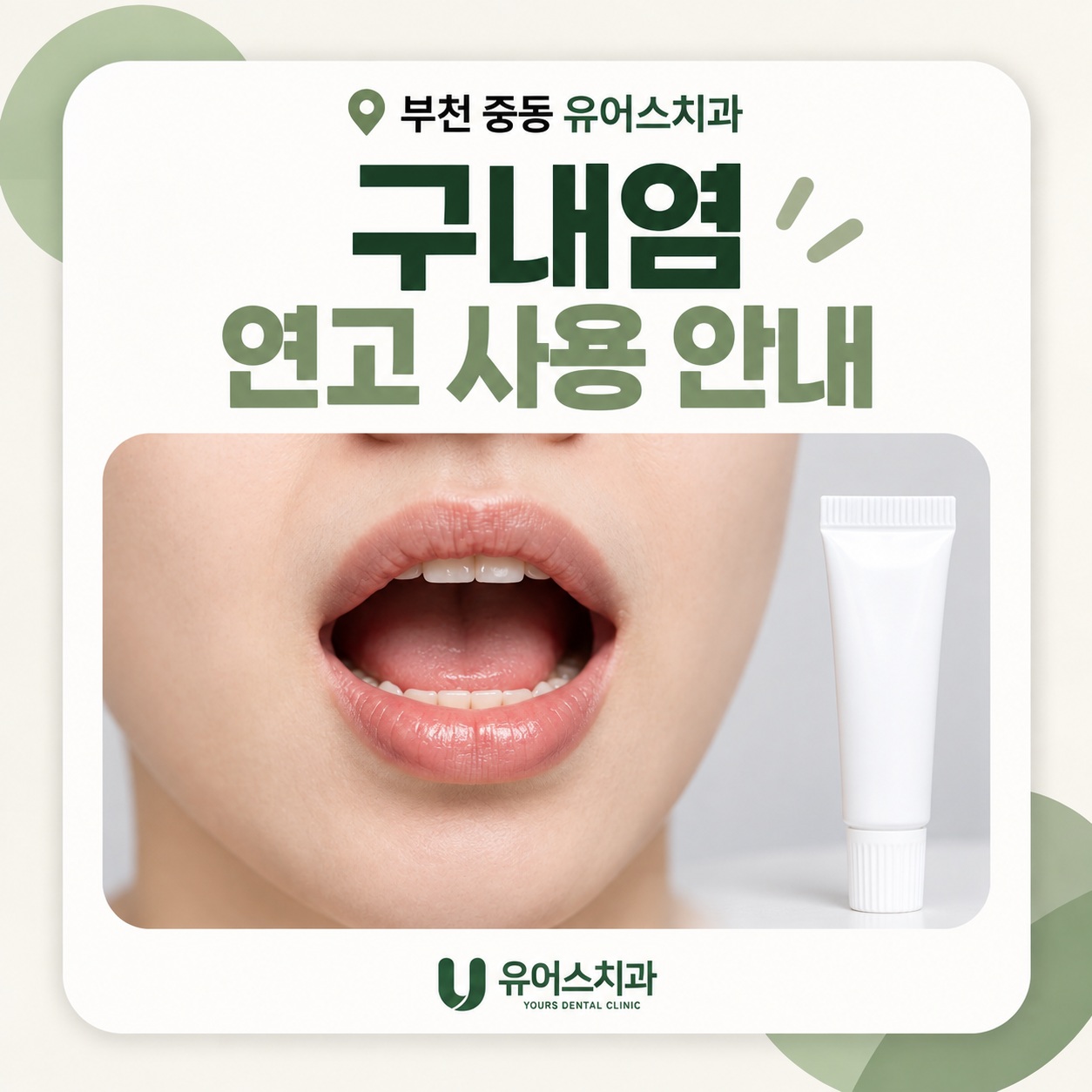 부천 중동 유어스치과 구내염 치료 연고와 가글 사용 시 주의사항