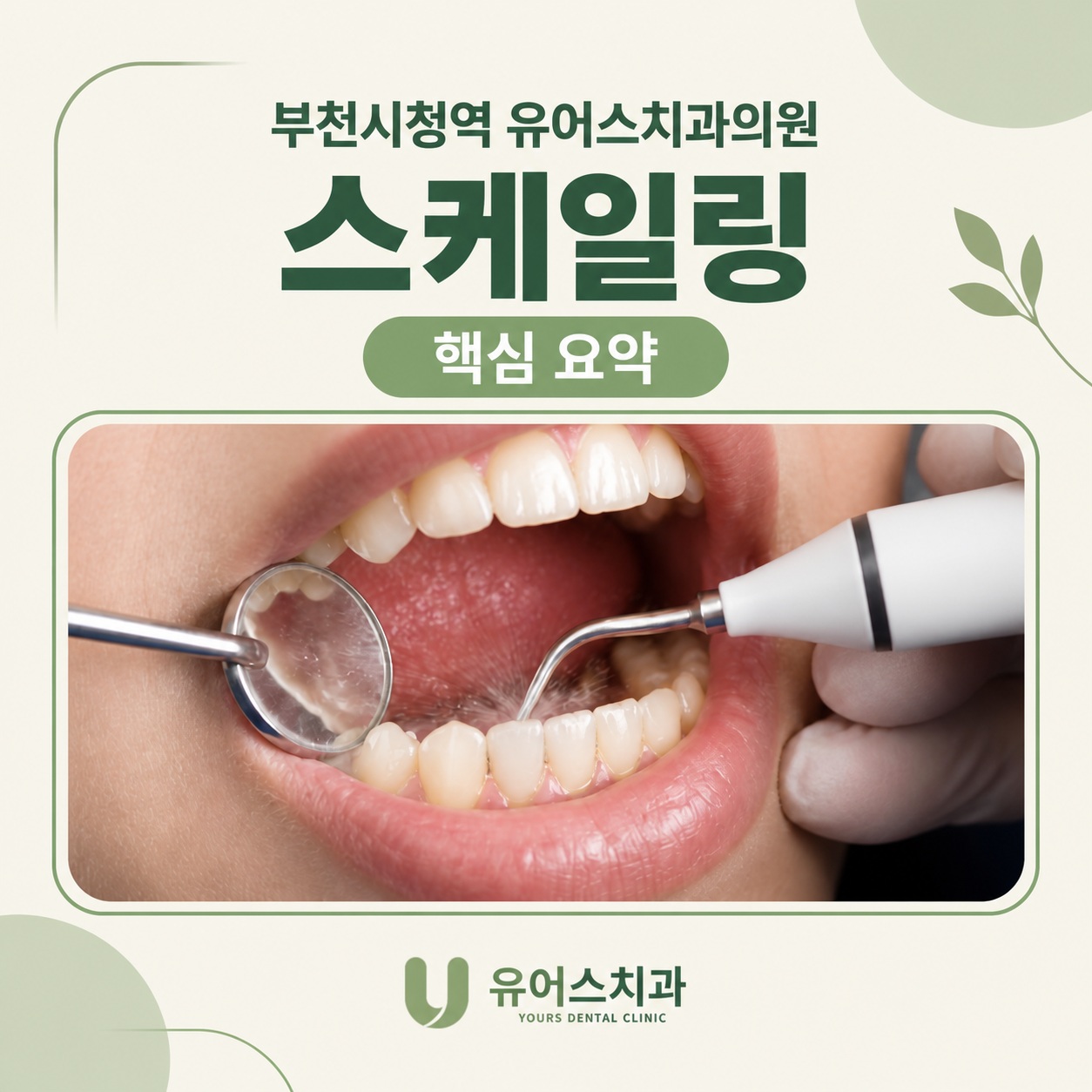 부천시청역 유어스치과의원 스케일링 핵심 요약과 치석 제거