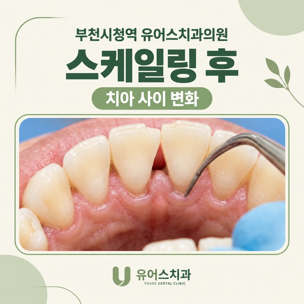 부천시청역 유어스치과의원 스케일링 후 치아 사이가 넓어 보이는 이유