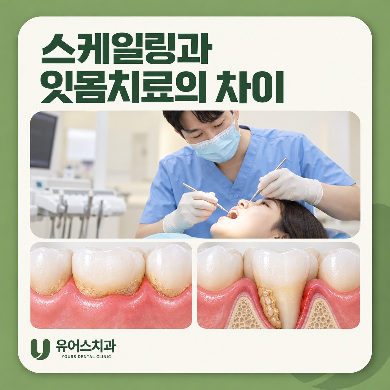 부천 유어스치과 스케일링과 잇몸치료 비교