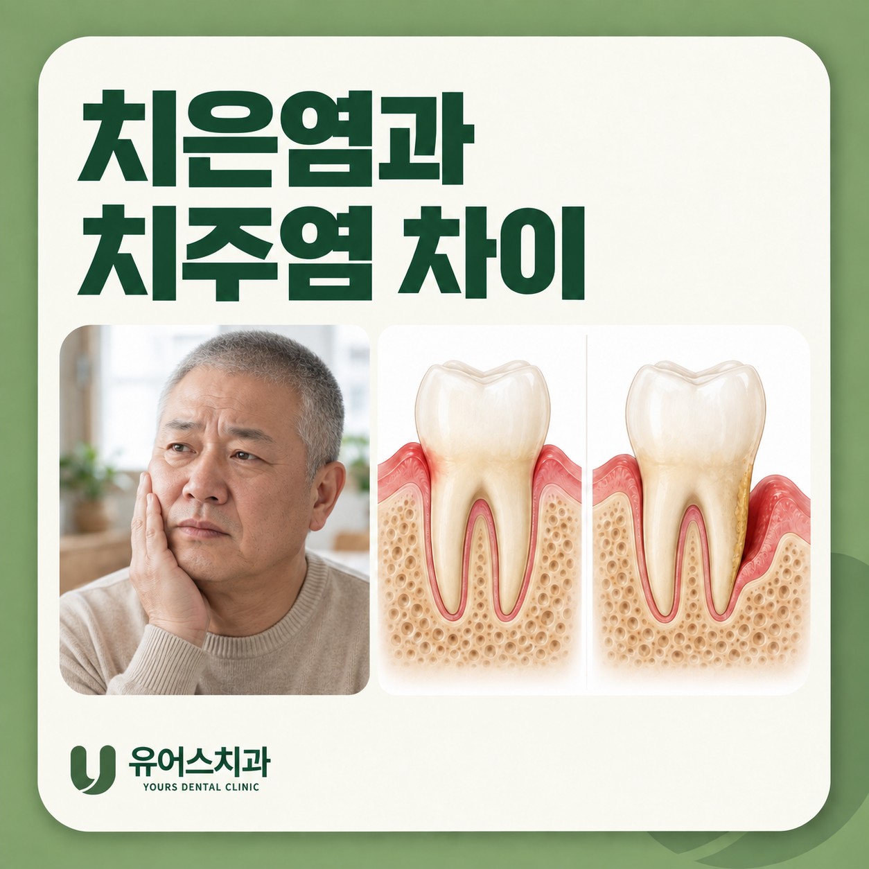 부천 유어스치과 치주질환 치은염과 치주염 비교