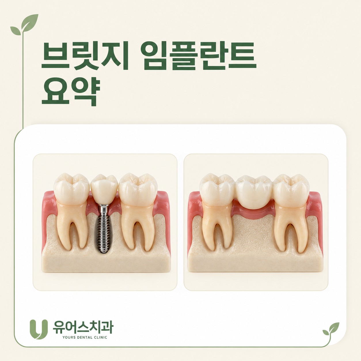 부천 상동역치과 브릿지 임플란트 핵심 요약