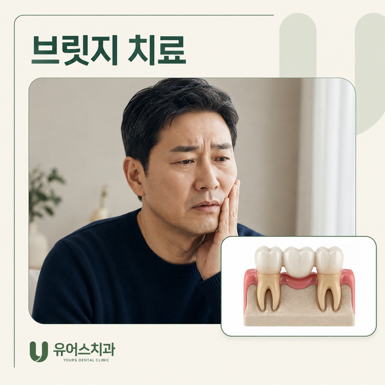 상동역치과 유어스치과 브릿지 치료 과정