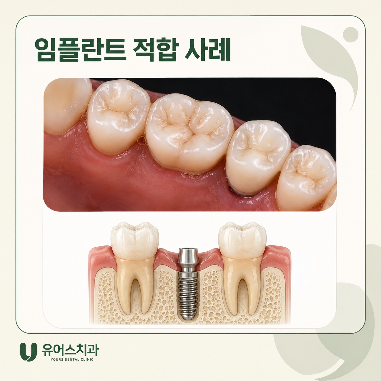 부천 상동역치과 임플란트 적합 사례 상담