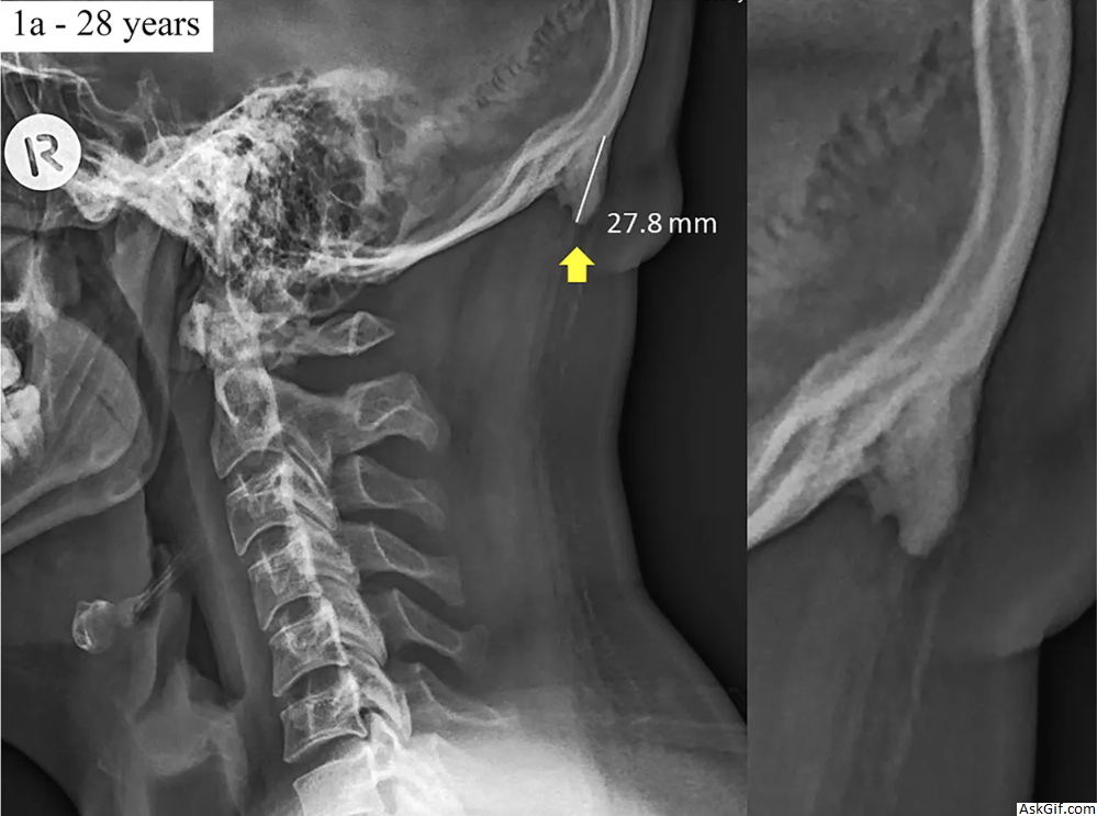 स्मार्टफोन का उपयोग युवा लोगों की खोपड़ी पर सींग उगाने के लिए करते हैं: अध्ययन