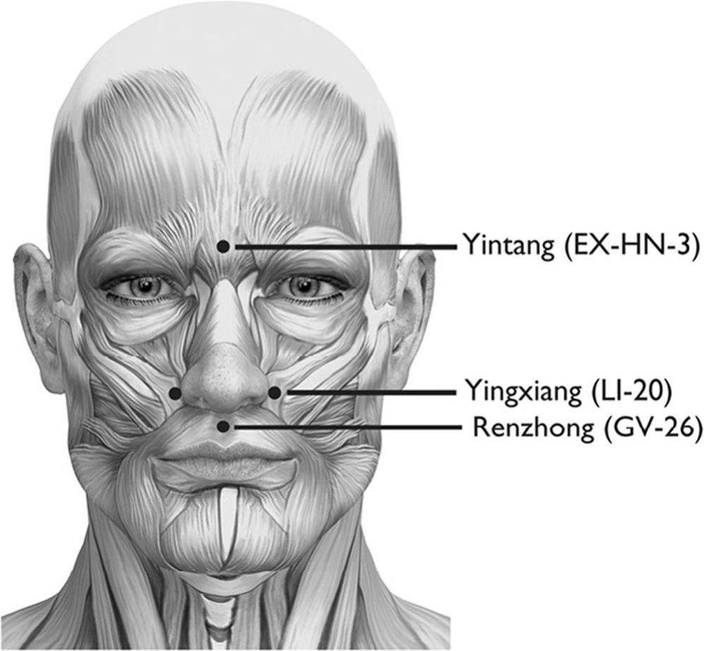 Các huyệt yintang, Nghinh Hương và Nhân Trung trên mặt