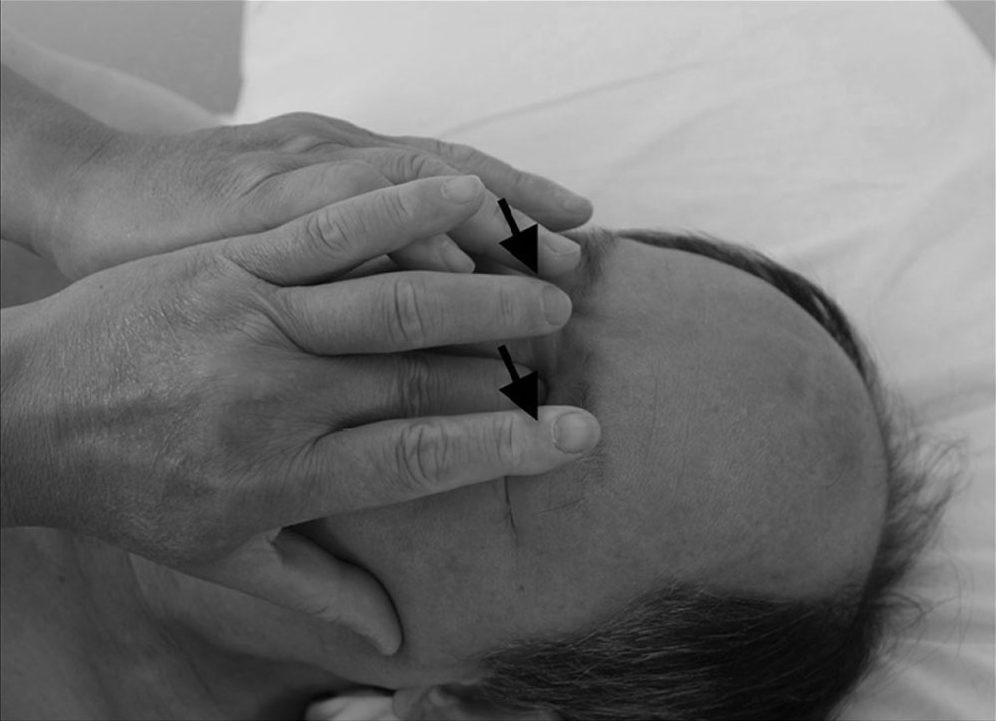 Bước 4 — ấn và rung huyệt jingming (睛明, BL-1)