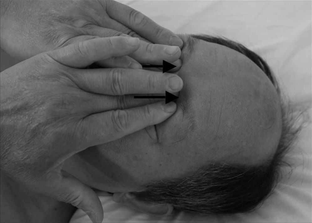 Bước 4 — ấn huyệt zanzhu (攢竹, BL-2) ở đầu trong lông mày