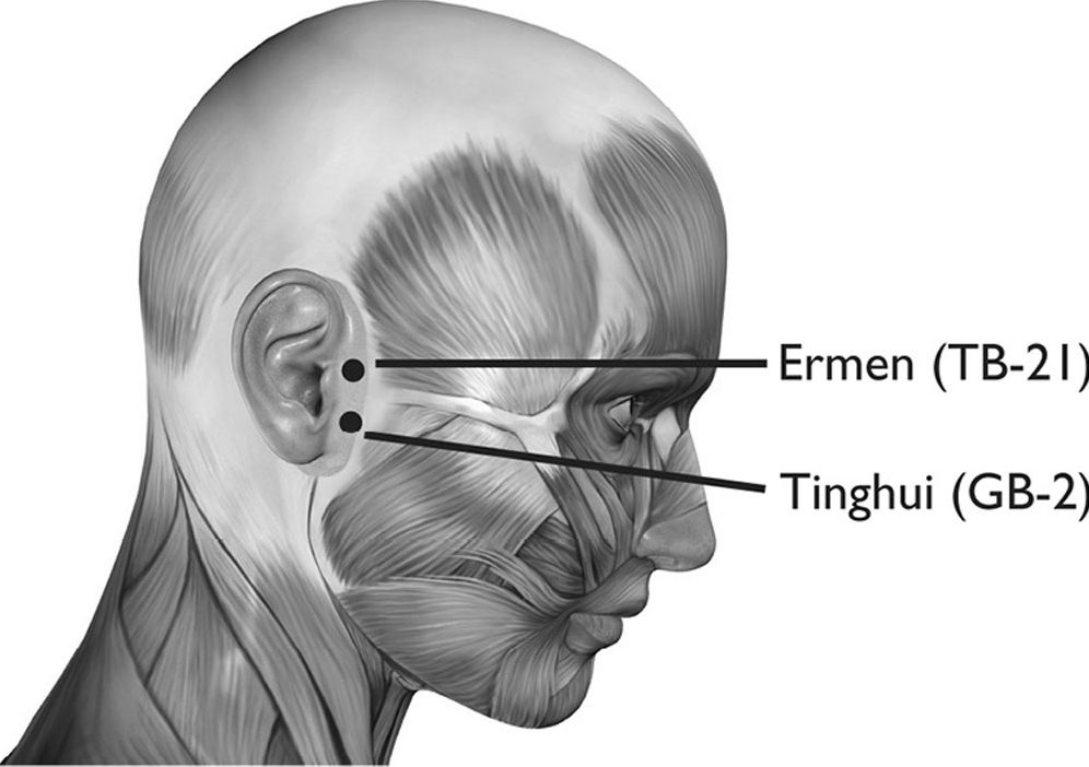 Các huyệt ermen (耳門, TB-21) và tinghui (聽會, GB-2)