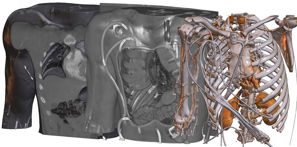 Chest CT