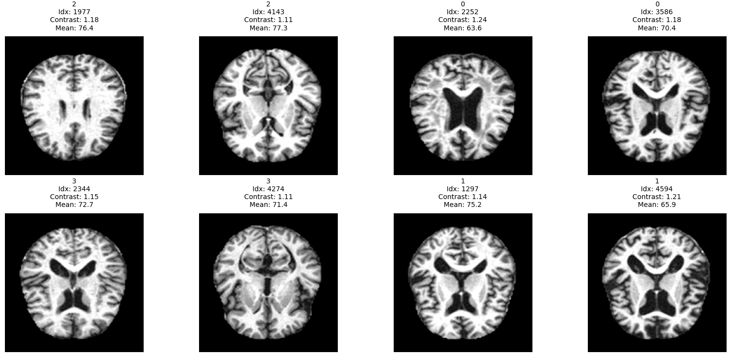 MRI Analysis
