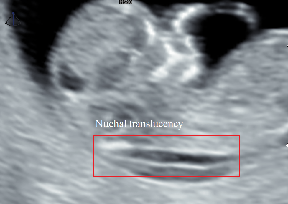 Nuchal translucency on fetal ultrasound images