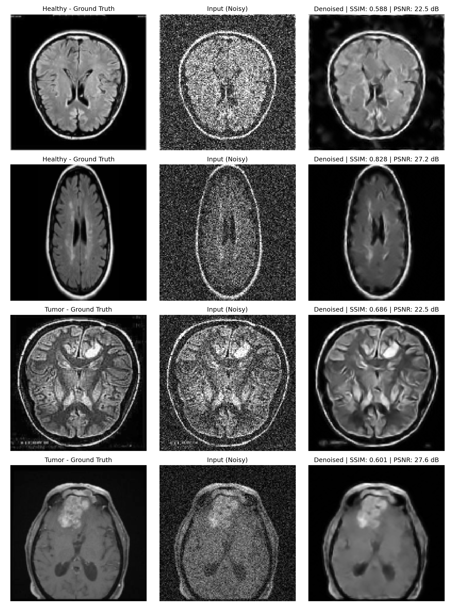 Qualitative MRI denoising examples