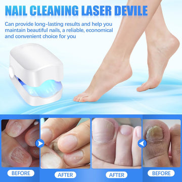 Rechargeable Nail Fungus Laser – Anti-Fungal Device Toenails, Hands & Feet (Home Use) - Lumae