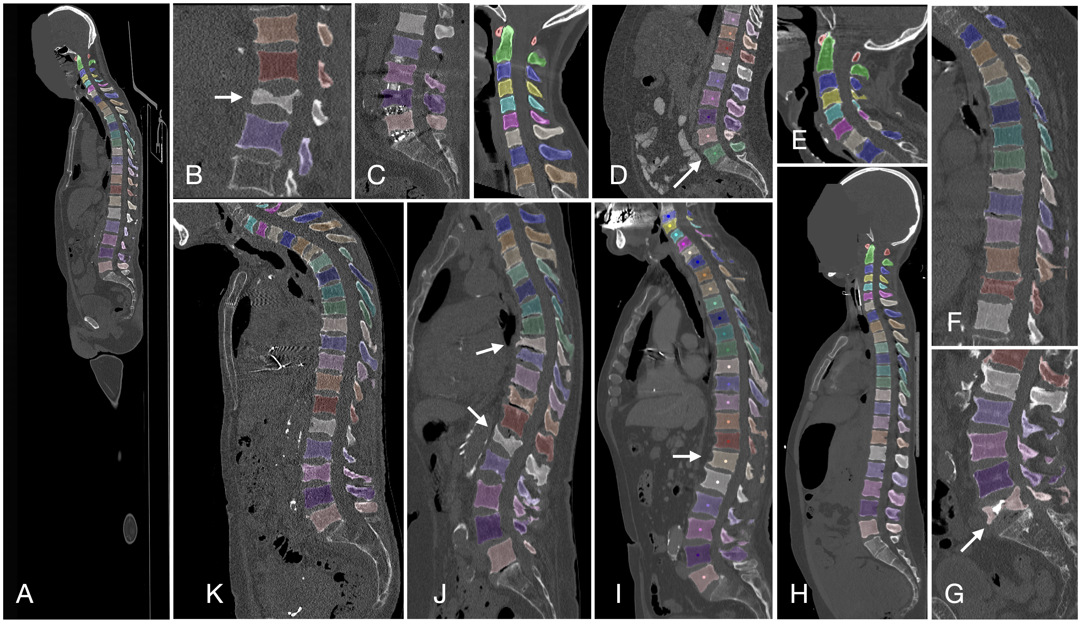 VerSe examples. Observe the variability in data: field-of-view, fractures, transitional vertebrae, etc.