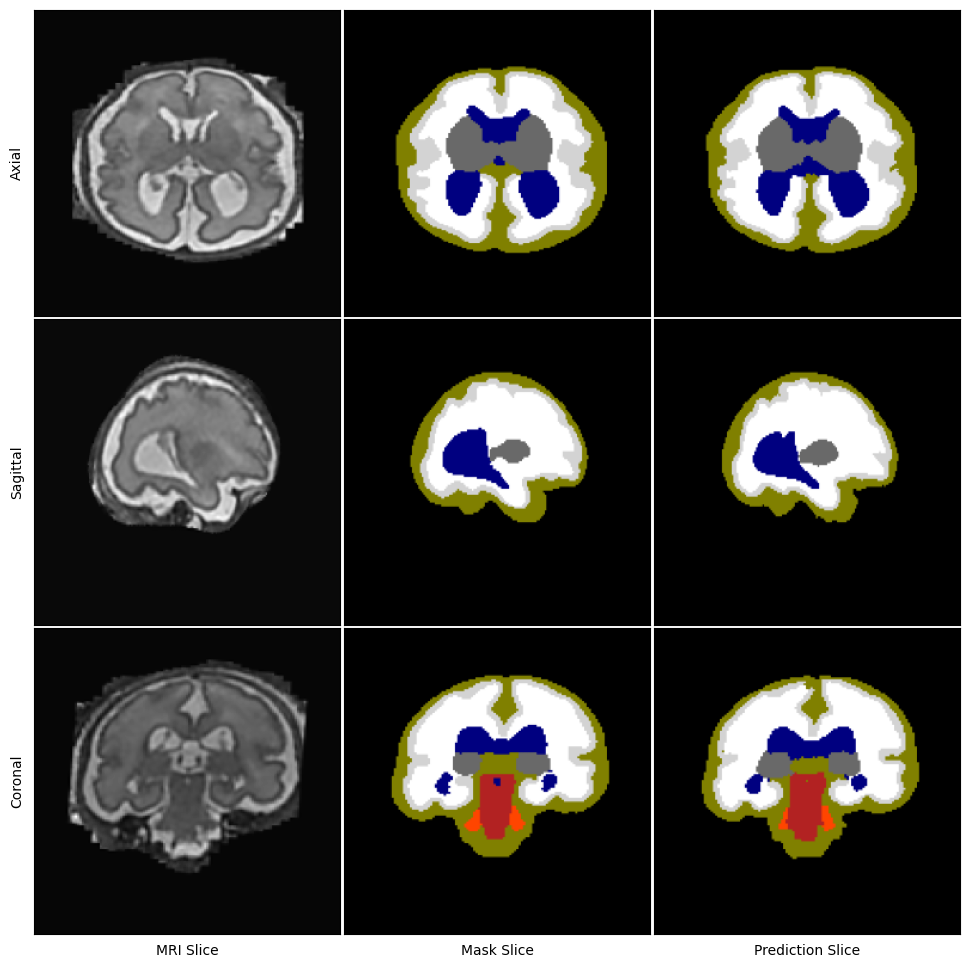 Segmentation outputs of 3D SDU-Net model.