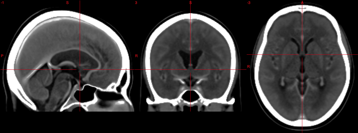 Screenshot of the CT template from the Clinical toolbox for SPM 8/2014 highlighting the ACPC line