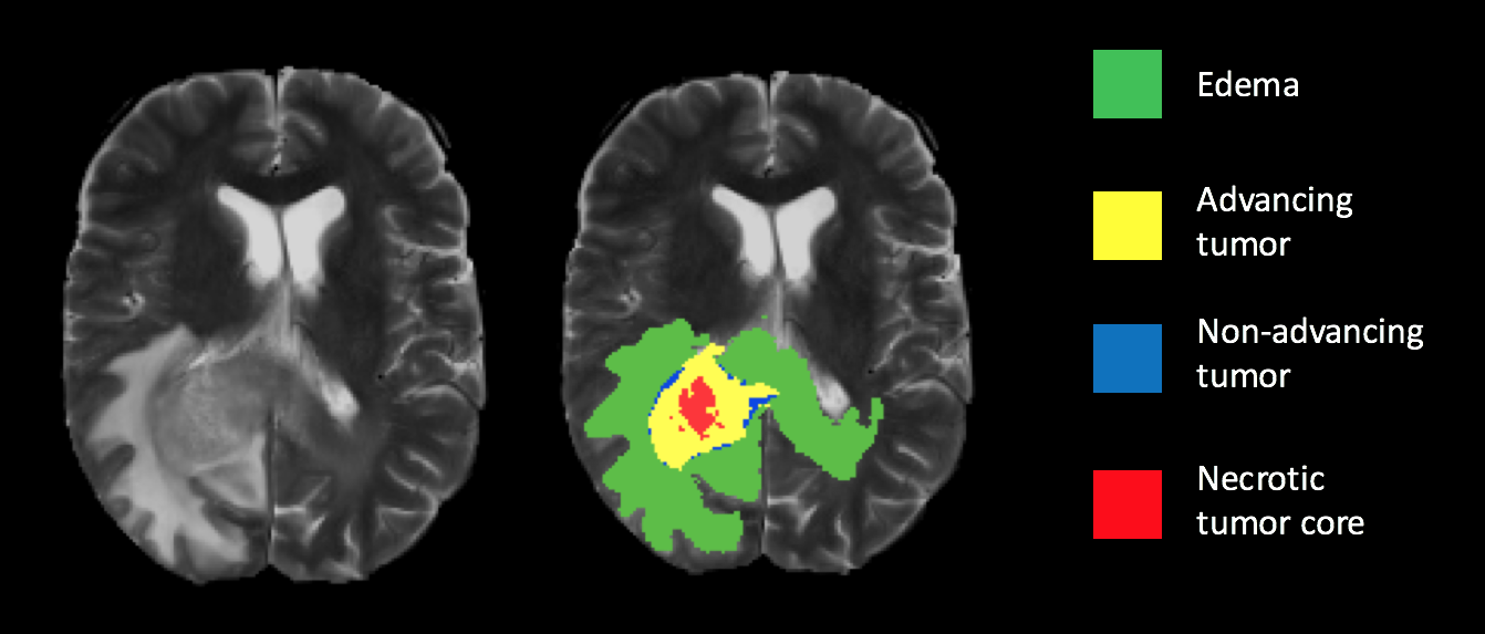 Example of tumor segmentation overlay on T2