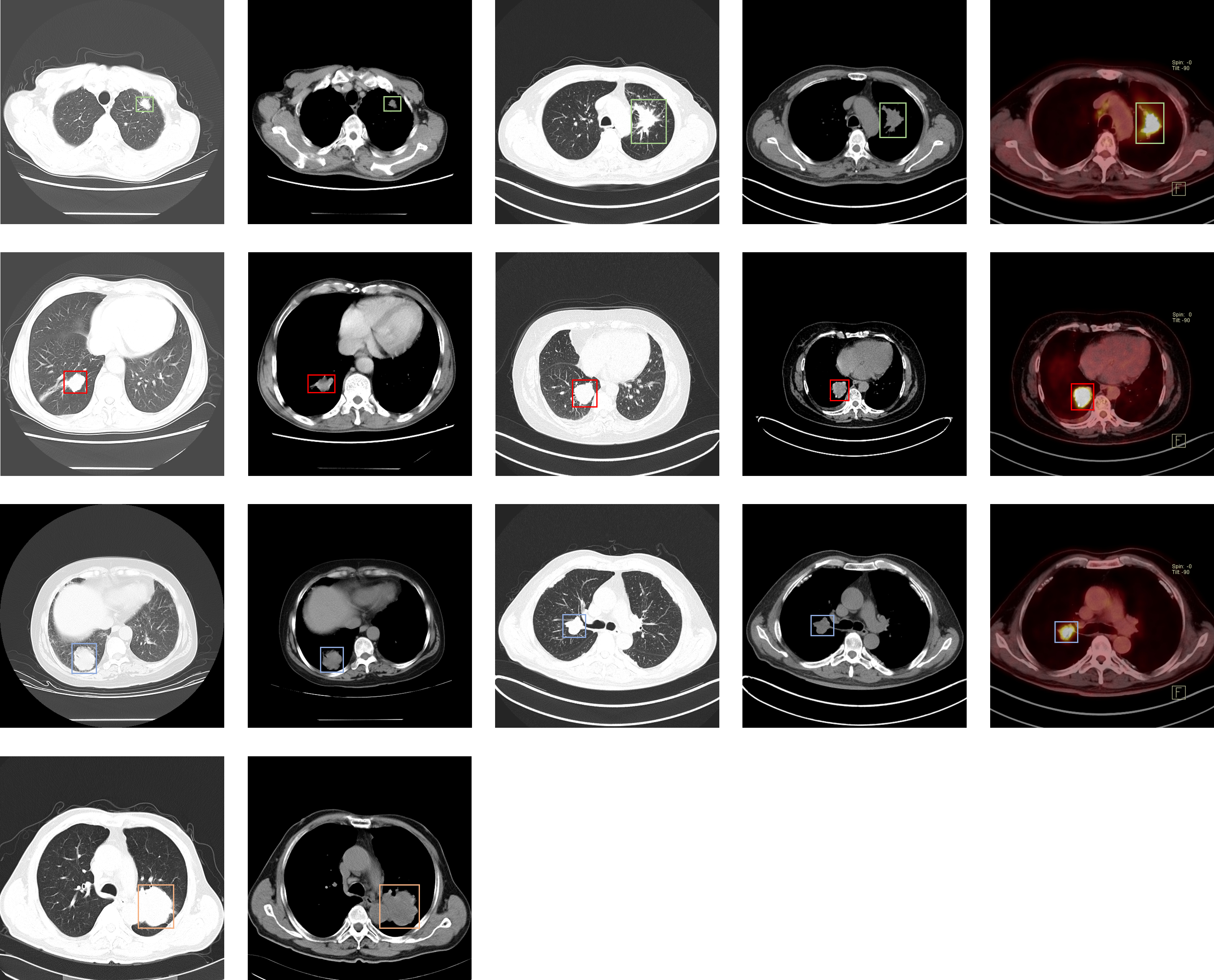 Lung-PET-CT-Dx