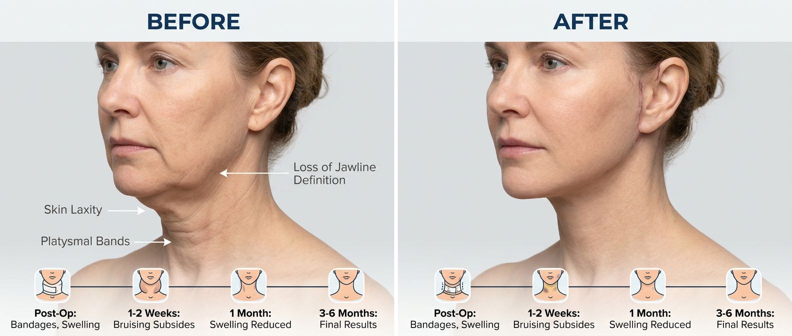 Neck Lift Surgery results and recovery - Neck Lift Surgery Huntington Beach