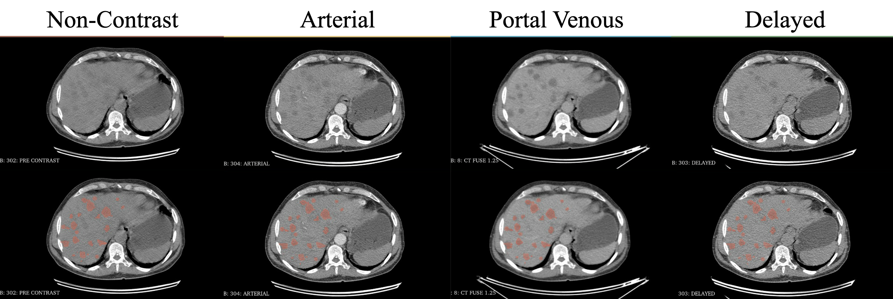 Four-phase CT acquisition with lesion annotations